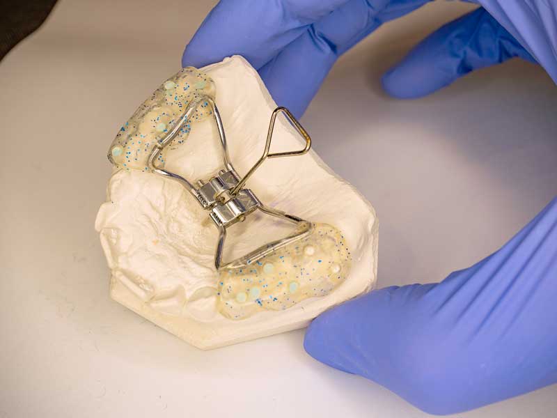 Palatal Expanders Palatal Expanders